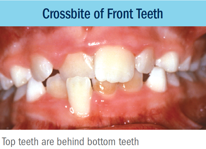 anterior crossbite bellevue orthodontist eastside braces.png
