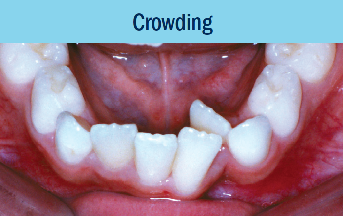 crowding bellevue orthodontist eastside braces.png