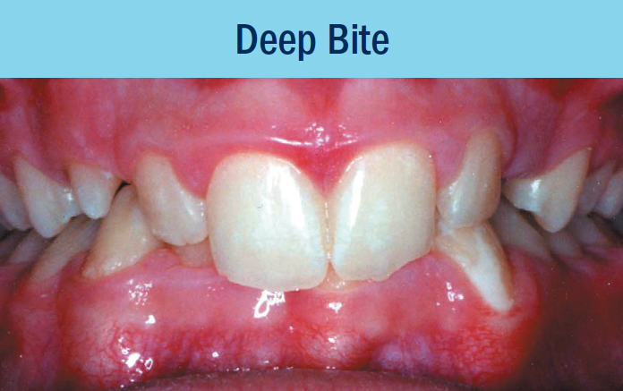 deep bite bellevue orthodontist eastside braces.png
