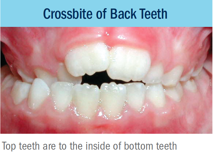 posterior crossbite bellevue orthodontist eastside braces.png