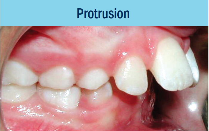 protrusion bellevue orthodontist eastside braces.png